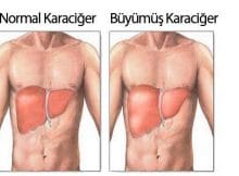 Karaciğer Büyümesi (Çocuk)