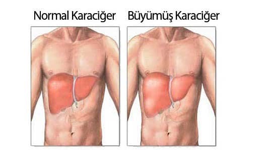 Karaciğer Büyümesi (Çocuk)