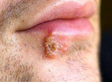 UÇUK (HERPES SİMPLEKS)