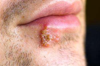 UÇUK (HERPES SİMPLEKS)