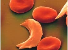 Orak Hücreli Anemi ( Sickle-cell Anemisi )