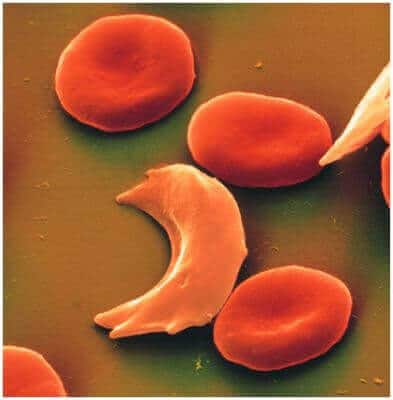 Orak Hücreli Anemi ( Sickle-cell Anemisi )