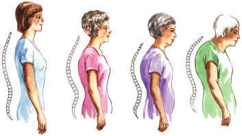 Osteoporoz (Kemik Erimesi)
