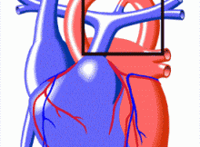 Patent Duktus Arteriyosus (PDA)