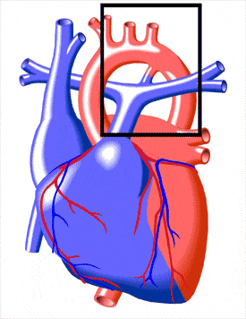 Patent Duktus Arteriyosus (PDA)
