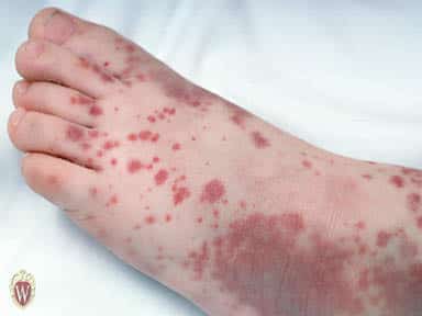 İdiopatik Trombositopenik Purpura