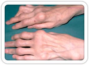 Romatoid Artrit (El)