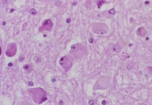 Sitomegalovirüs (CMV)