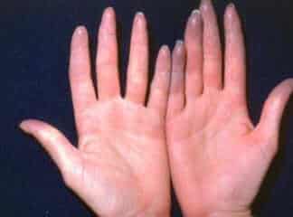 Skleroderma