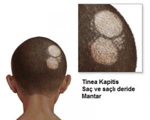 Tinea Kapitis