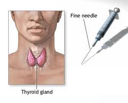 Tiroidit